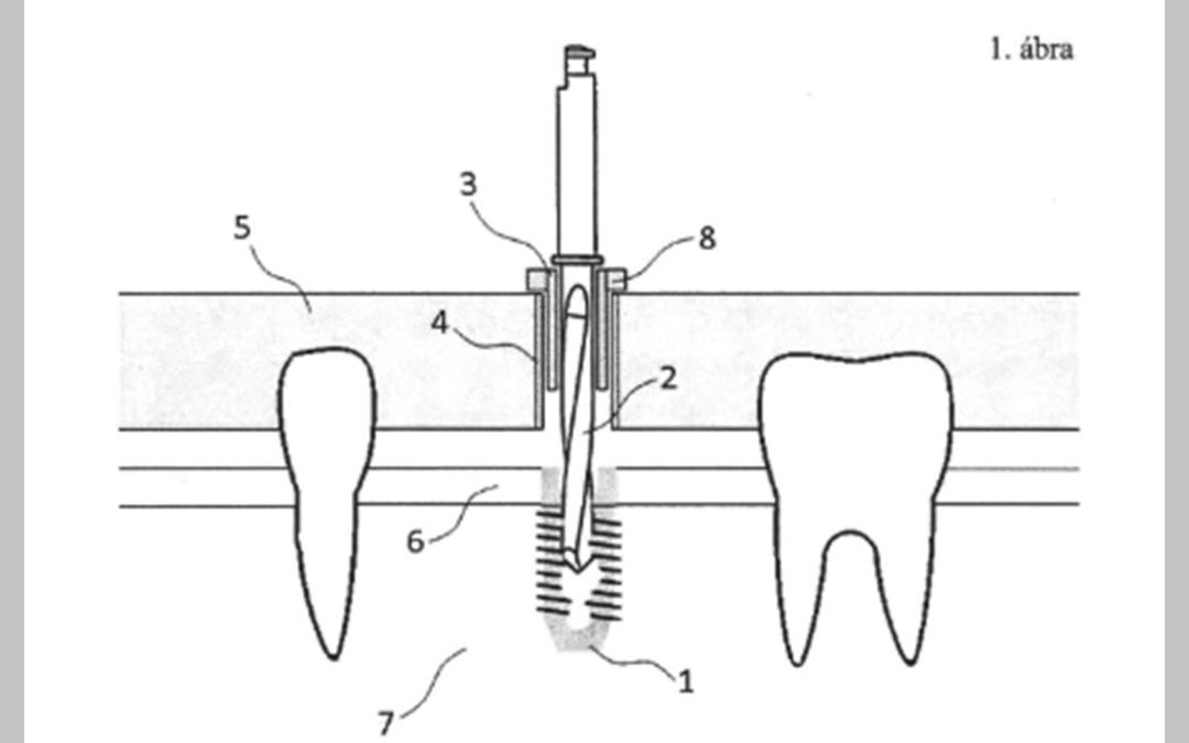 Process for the dynamic determination of the length of drill and guide used for dental implantation surgery